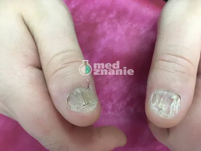🔥 Burn of the nail plate 😱😫 part 2 🔥 Onycholysis of nails - YouTube