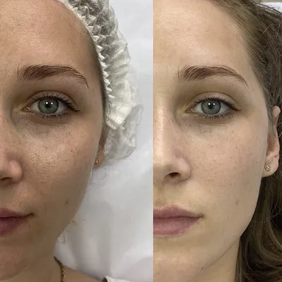 Лазерный пилинг (дермабразия) кожи лица: противопоказания, уход , фото до и  после процедуры