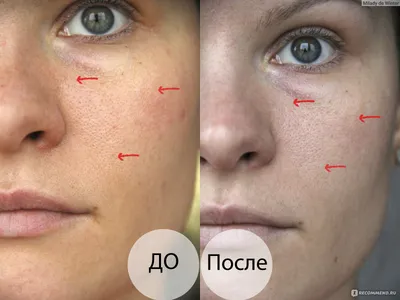 Срединный пилинг лица в Кишиневе и Харькове |Honest Beauty