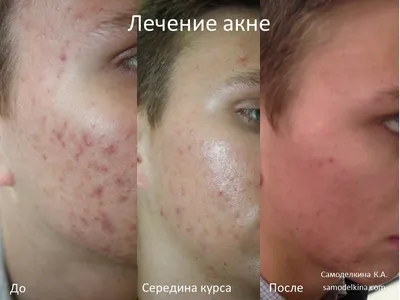 Химический пилинг лица - Киев | Diamond Laser