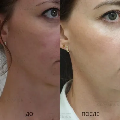 Миндальный пилинг лица: фото до и после, отзывы специалистов, как проходит  процедура