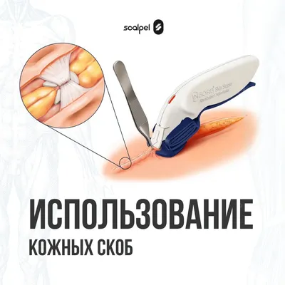 VVDental Outlet Store, 1 шт., держатель стоматологических ортодонтических  игл, стандартные 14 см хирургические скобы, пинцет rtodoncia 0 | AliExpress