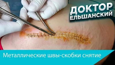 Скобы и брекеты