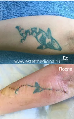 Хирургическое удаление татуировок: операция в Москве. Последствия татуировок  | Интернет-журнал Estetmedicina.ru