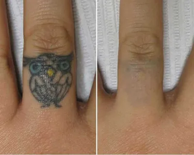 Лазерное выведение татуировки | блог Эстетик-Сервис