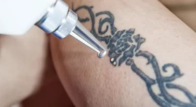 Удаление татуировок неодимовым лазером на лице в СПб