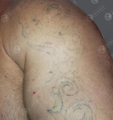 Удаление татуировок пикосекундным лазером Picosure - Vip Clinic.  Пикосекундный лазер удаление тату в Москве. Доступные цены