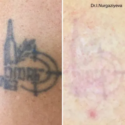Можно ли удалить тату без шрамов: обзор всех методов сведения татуировок и  их преимуществ | Косметология и эстетическая медицина | Дзен