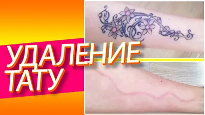 Удаление татуировки хирургическим путем. Цветное тату на руке - YouTube