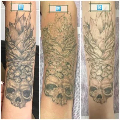 Удаление татуировок и татуажа с помощью лазера - Медицинский центр  \"Пигмалион\" в Курске