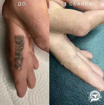 Как свести татуировку без шрамов и без следа