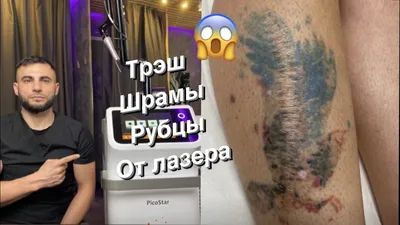 Удаление татуировки — как выглядит кожа после процедуры, о чем стоит знать  / AdMe