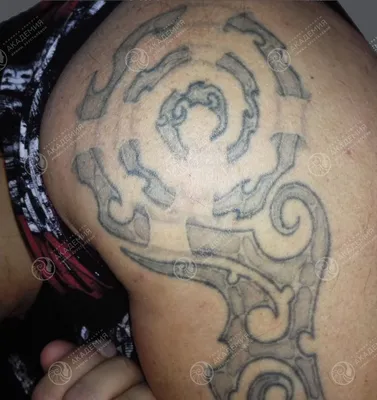 Удаление татуировок лазером - «Неудачный опыт удаления тату» | отзывы