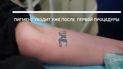 Удаление татуировок пикосекундным лазером Picosure - Vip Clinic.  Пикосекундный лазер удаление тату в Москве. Доступные цены