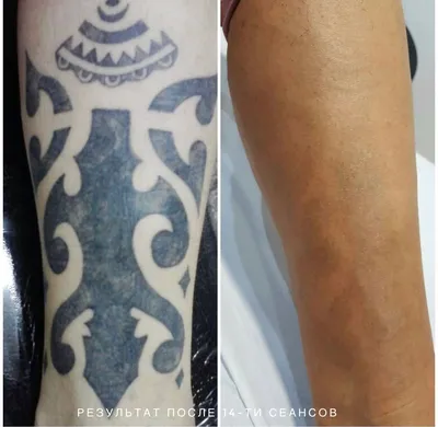Удаление татуировок и татуажа: методы, особенности, описание процедуры -  Клиника \"Отражение\"