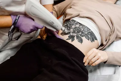 Способы удаления татуировок | Способы выведения тату