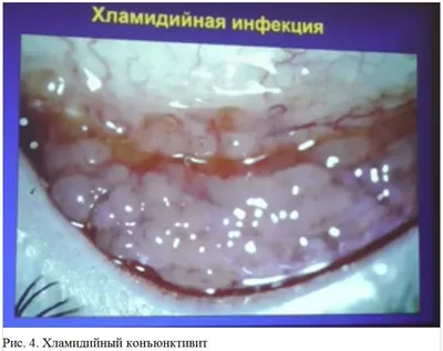 Рис. 4. Хламидийный конъюнктивит