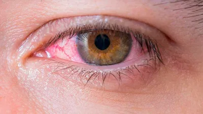 Red Eye. Современные аспекты диагностики и лечения хламидийного поражения  глаз. | Орган Зрения