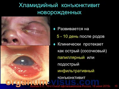 Red Eye. Современные аспекты диагностики и лечения хламидийного поражения  глаз. | Орган Зрения