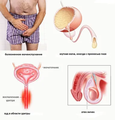 Хламидиоз (хламидия трахоматис) - причины появления, симптомы заболевания,  диагностика и способы лечения
