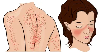 Гиперпигментация кожи лица и тела — что это, причины, виды, лечение