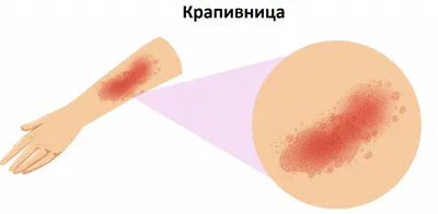Крапивница: причины и лечение крапивницы в клинике СПб