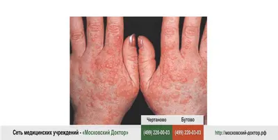 Сыпь на пальце: возможные причины и способы лечения