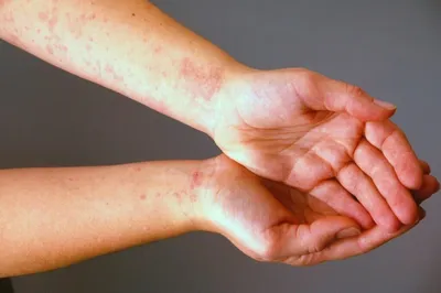 Холодовая аллергия на руках и других участках тела: виды патологии и как  лечить аллергию на холод