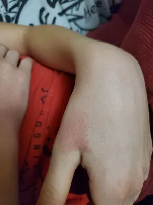 Аллергия на руках: причины, симптомы и лечение | Beauty HUB | Дзен