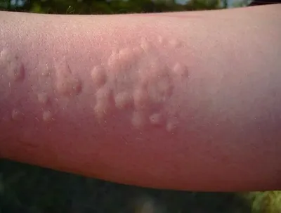 Холодовая аллергия. Как защитить кожу от холодового дерматита? - YouTube