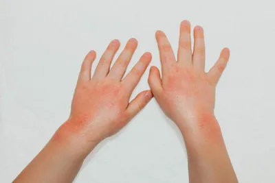 Отзыв о Крем Акрихин \"Акридерм ГК\" | Отлично справился с холодовой  аллергией (дерматитом) на руках!
