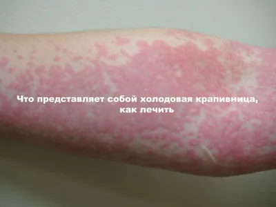 Причины раздражения кожи и обзор 4 бьюти-средств, успокаивающих кожу