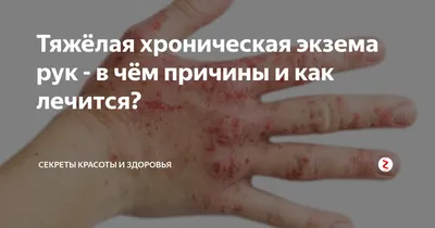 Экзема