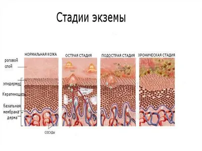 ᐈ Как лечить экзему? ~【Симптомы и диагностика в Киеве】