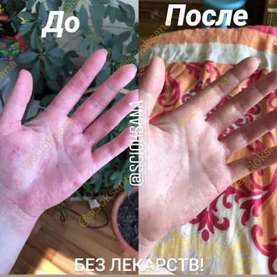 В браке с мужем обострилось хроническое заболевание, и еще появилась экзема:  к чему привела семейная жизнь | Записки неидеальной мамы | Дзен