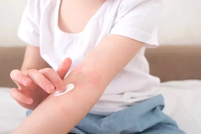 Экзема на руках: причины и лечение экземы на кистях и пальцах рук