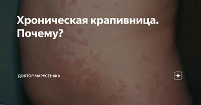 Хроническая идиопатическая крапивница: причины, симптомы, сколько длится,  лечение