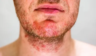 Причины стрессовой сыпи на лице и теле, высыпания на коже при стрессе