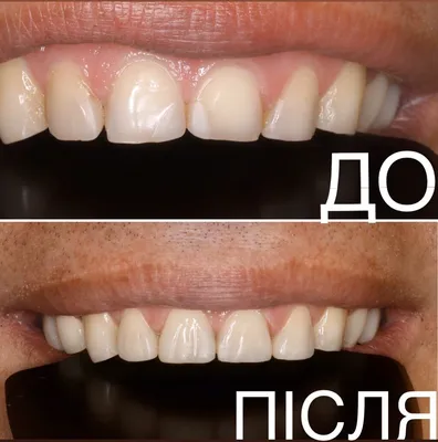 Художественная реставрация зубов. Дантист Орск.
