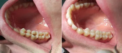 Реставрация зубов в Ирпене, цена на наращивание зуба в Буче