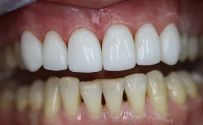 Художественная реставрация зубов | Показания и методы | Клиника семейной  стоматологии Дока-Дент