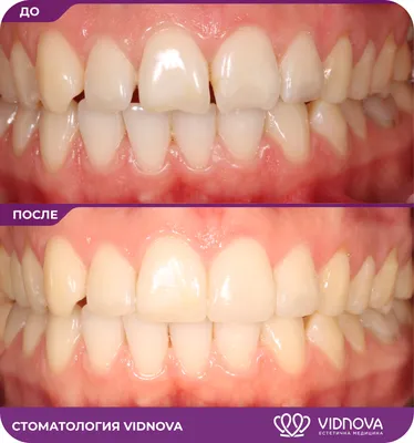 Сколько стоит художественная реставрация передних верхних зубов в  Челябинске? Dominanta74