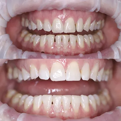 Эстетическая реставрация зубов - Стоматология Vidnova