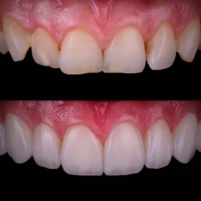 Как долго выглядят красиво зубы после реставрации? • ДентаЛэнд