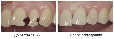 Художественная реставрация зубов в Харькове, Чугуеве - виниры на зубы