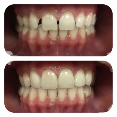 Фото до и после реставрации зубов в Волжском в клинике «ДАША»