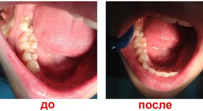 Художественная реставрация зубов фото до и после фото