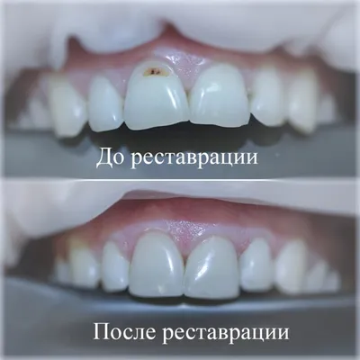 Композитная реставрация зубов в Санкт-Петербурге
