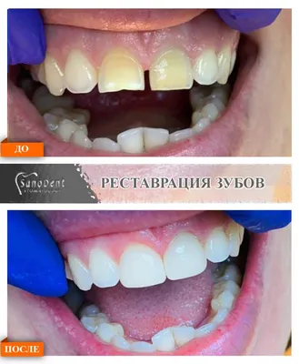Художественная реставрация зубов в клинике \"Элль Вояж\"