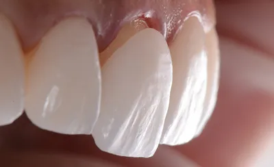 Реставрация зубов в СПБ - Цена на эстетическую и художественную реставрацию  зубов в стоматологии Вашъ Дантистъ